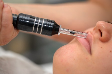 ošetrenie s Hyaluron pen